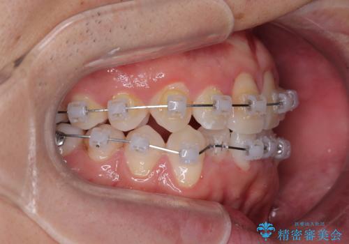 マウスピース矯正と迷った結果…管理のしやすさで選んだクリアブラケット矯正の症例の治療中