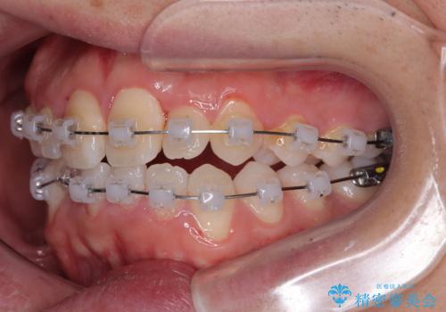 マウスピース矯正と迷った結果…管理のしやすさで選んだクリアブラケット矯正の症例の治療中