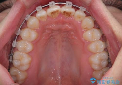マウスピース矯正と迷った結果…管理のしやすさで選んだクリアブラケット矯正の症例の治療中