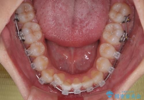 マウスピース矯正と迷った結果…管理のしやすさで選んだクリアブラケット矯正の症例の治療中