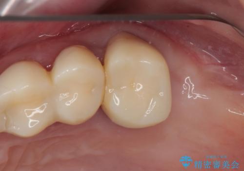 かかりつけ医の治療方針に疑問 歯周病治療と矯正治療を合わせた総合歯科治療の治療前