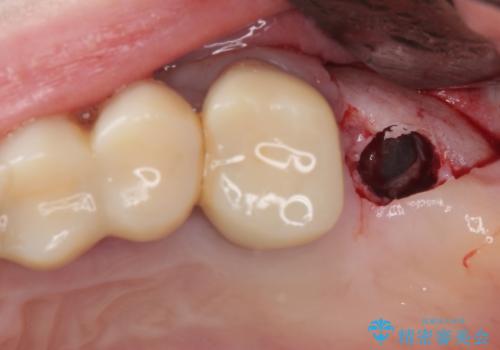 かかりつけ医の治療方針に疑問 歯周病治療と矯正治療を合わせた総合歯科治療の治療中