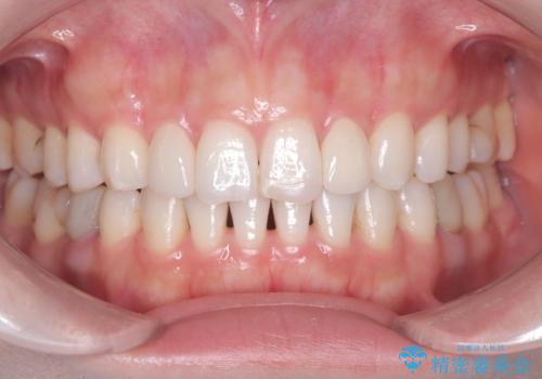 矯正後、矮小歯をオールセラミッククラウンで審美修復の治療後