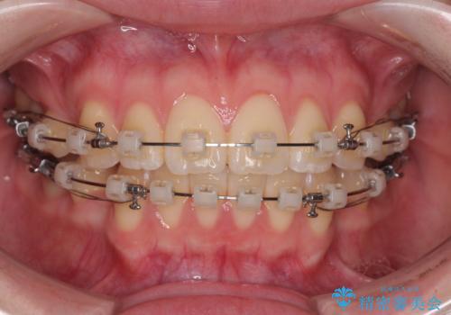 飛び出した前歯を引っ込める　ワイヤー装置での抜歯矯正治療の治療中