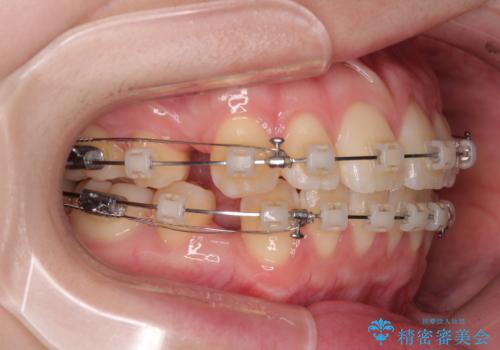 飛び出した前歯を引っ込める　ワイヤー装置での抜歯矯正治療の治療中
