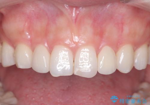 矯正後、矮小歯をオールセラミッククラウンで審美修復の治療後