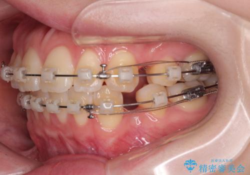 飛び出した前歯を引っ込める　ワイヤー装置での抜歯矯正治療の治療中