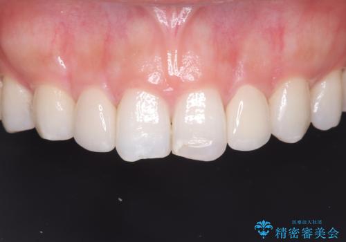 矯正後、矮小歯をオールセラミッククラウンで審美修復