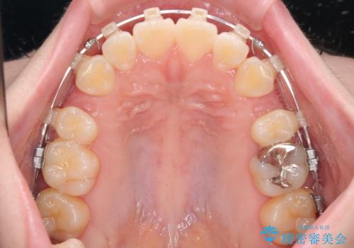 飛び出した前歯を引っ込める　ワイヤー装置での抜歯矯正治療の治療中