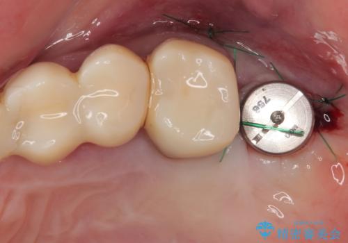 かかりつけ医の治療方針に疑問 歯周病治療と矯正治療を合わせた総合歯科治療の治療後