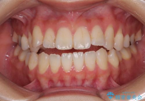 舌の突出癖が原因 インビザライン矯正による開咬改善の治療前