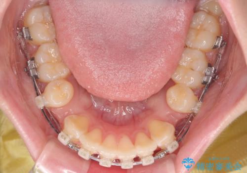 飛び出した前歯を引っ込める ワイヤー装置での抜歯矯正治療の治療中