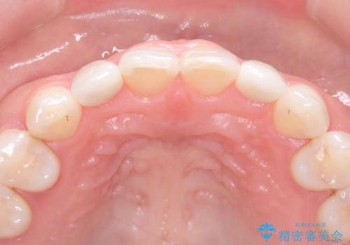 矯正後、矮小歯をオールセラミッククラウンで審美修復の治療後