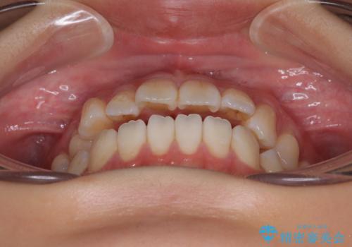 舌の突出癖が原因　インビザライン矯正による開咬改善の治療前