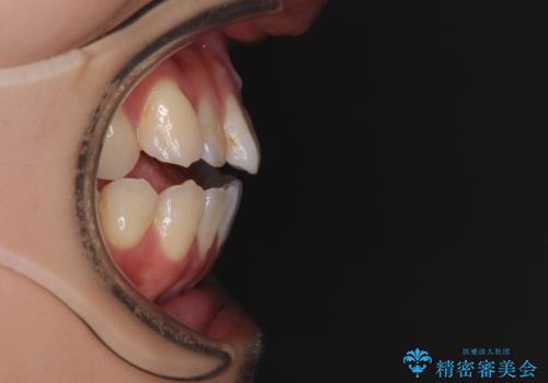 舌の突出癖が原因 インビザライン矯正による開咬改善の治療前