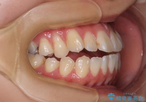 舌の突出癖が原因 インビザライン矯正による開咬改善の治療前