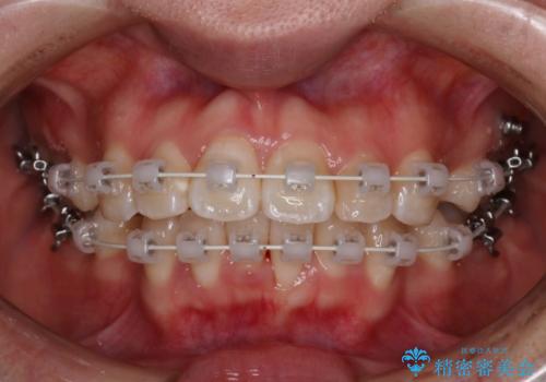 【審美装置】口元を下げたいの治療中