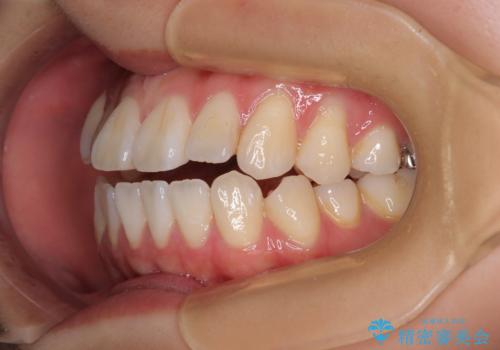 舌の突出癖が原因　インビザライン矯正による開咬改善の治療前