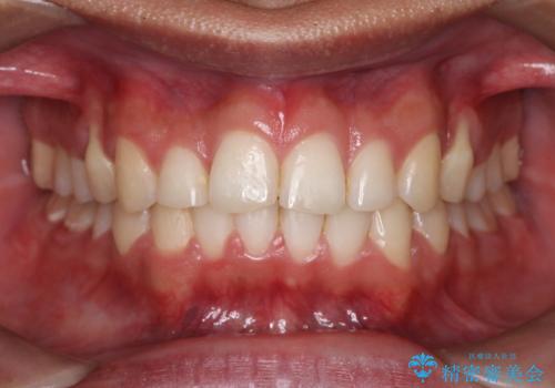 デコボコも深いかみ合わせも…“全部気になる”を一気に解決の治療後