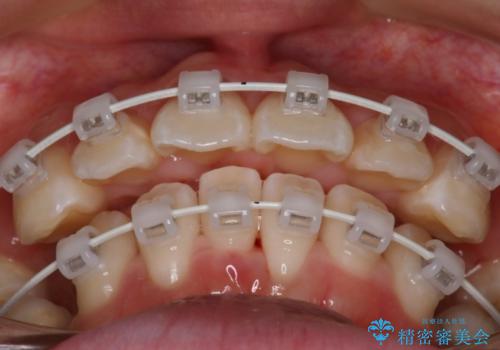 【審美装置】口元を下げたいの治療中