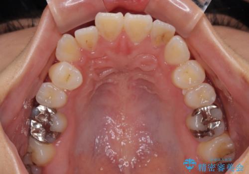 舌の突出癖が原因 インビザライン矯正による開咬改善の治療前