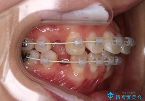 【審美装置】口元を下げたいの治療中