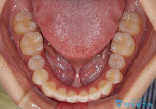 舌の突出癖が原因　インビザライン矯正による開咬改善の治療前