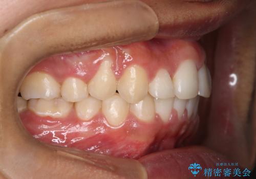 デコボコも深いかみ合わせも…“全部気になる”を一気に解決の治療後