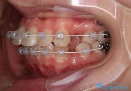 【審美装置】口元を下げたいの治療中