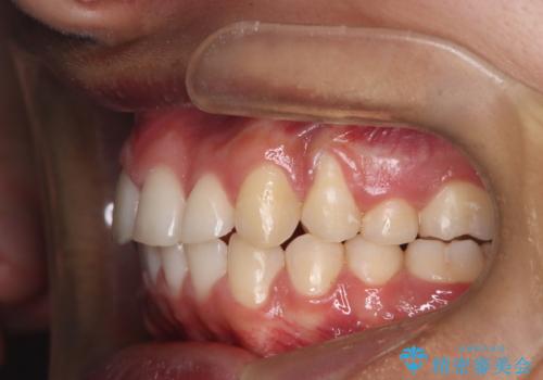 デコボコも深いかみ合わせも…“全部気になる”を一気に解決の治療後