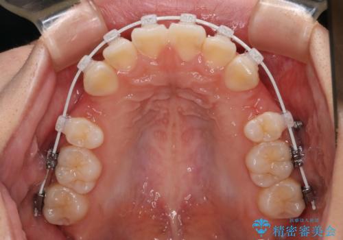 【審美装置】口元を下げたいの治療中