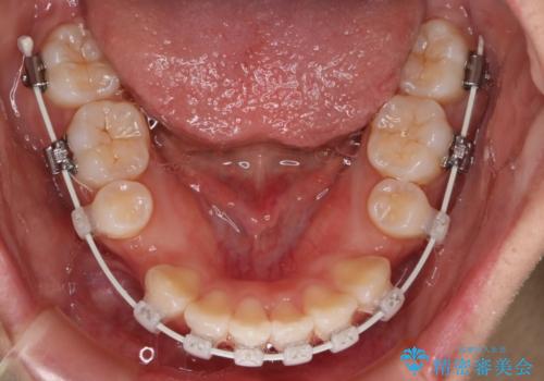【審美装置】口元を下げたいの治療中