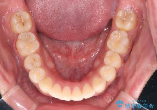 デコボコも深いかみ合わせも…“全部気になる”を一気に解決の治療後