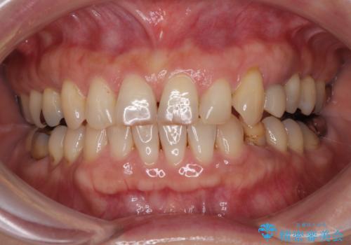 ぐらつく乳犬歯を抜歯即時インプラントで短期間に機能回復