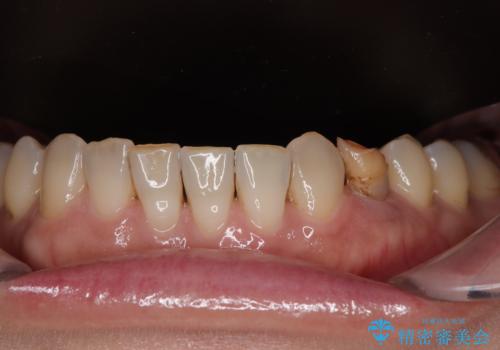 ぐらつく乳犬歯を抜歯即時インプラントで短期間に機能回復の治療前