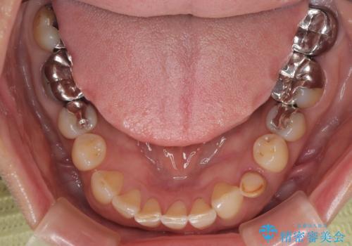 ぐらつく乳犬歯を抜歯即時インプラントで短期間に機能回復の治療前