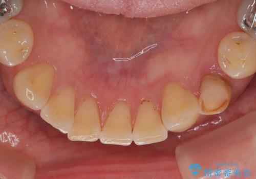 ぐらつく乳犬歯を抜歯即時インプラントで短期間に機能回復の治療前