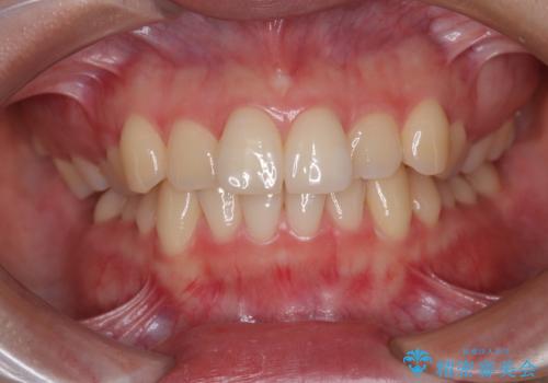 インビザラインの自己管理は煩わしい ワイヤー矯正で短期間矯正治療の治療前