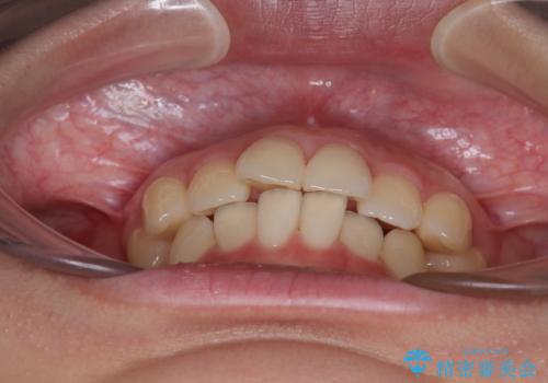 インビザラインの自己管理は煩わしい ワイヤー矯正で短期間矯正治療の治療前