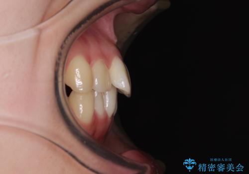 インビザラインの自己管理は煩わしい ワイヤー矯正で短期間矯正治療の治療前