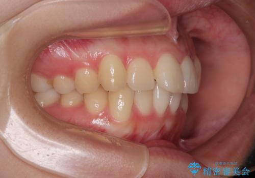 インビザラインの自己管理は煩わしい　ワイヤー矯正で短期間矯正治療の治療前