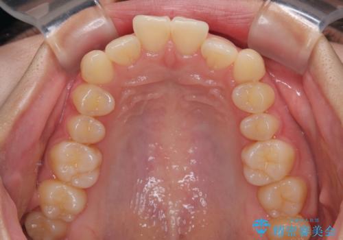 インビザラインの自己管理は煩わしい ワイヤー矯正で短期間矯正治療の治療前