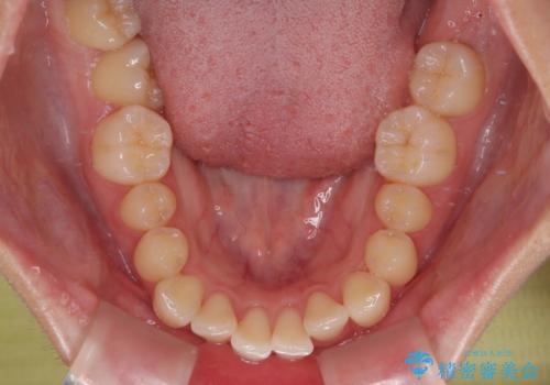 インビザラインの自己管理は煩わしい ワイヤー矯正で短期間矯正治療の治療前
