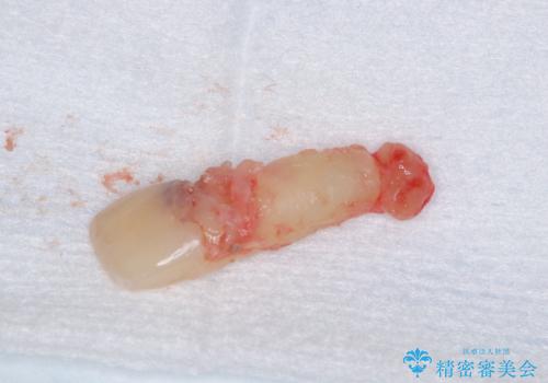 歯根吸収した前歯　短期間でのインプラント治療の治療前