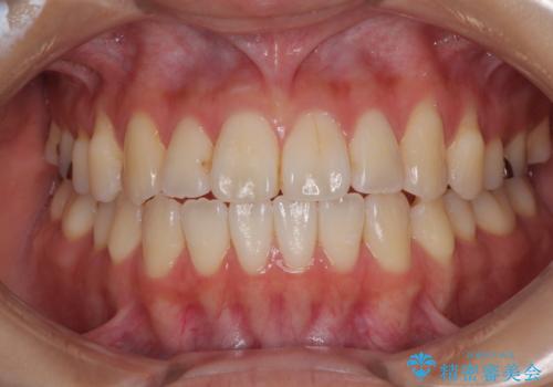 舌の突出癖が原因　インビザライン矯正による開咬改善の治療後