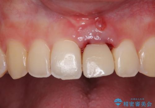 歯根吸収した前歯 短期間でのインプラント治療の治療中