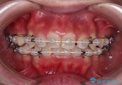 口ゴボが気になる　上下4本の抜歯矯正の治療中