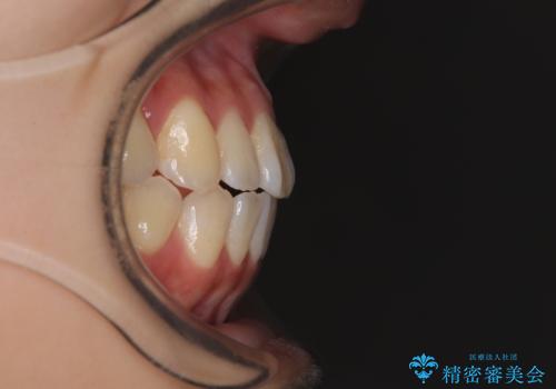 舌の突出癖が原因　インビザライン矯正による開咬改善の治療後