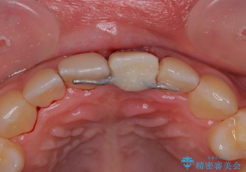 歯根吸収した前歯 短期間でのインプラント治療の治療後