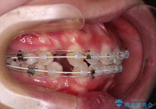 口ゴボが気になる　上下4本の抜歯矯正の治療中